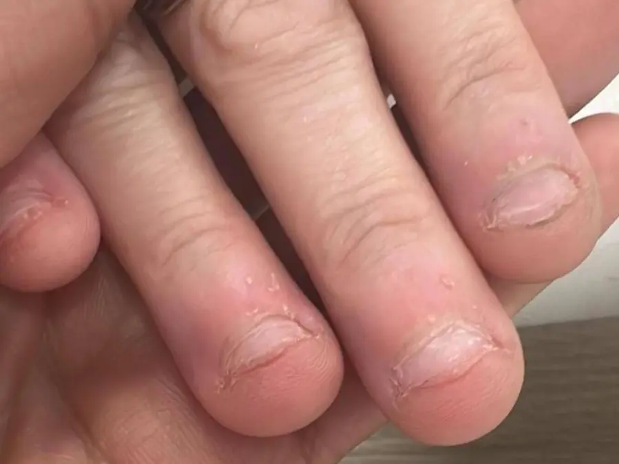 DEJAR DE MORDERTE LAS UÑAS