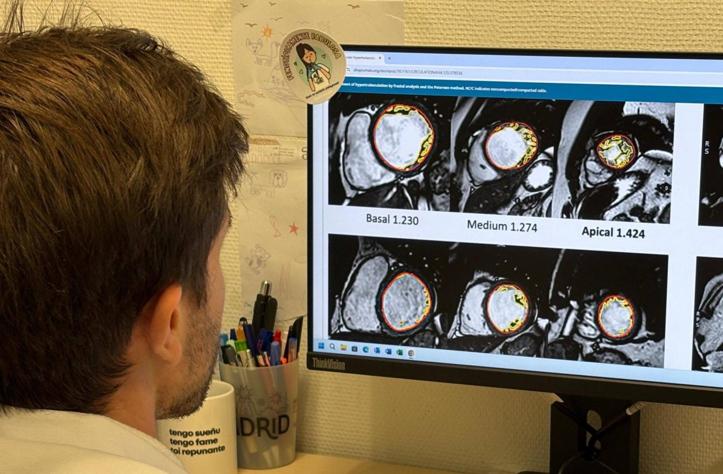 
                                                    Un estudio en el que participa el Hospital Puerta de Hierro descarta la existencia de una enfermedad del corazón